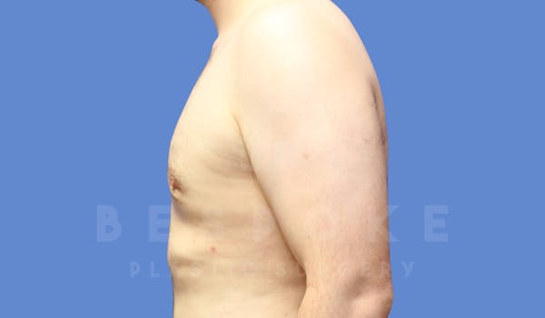 Gynecomastia Before & After Gallery - Patient 144170618 - Image 6