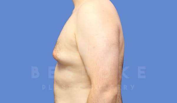 Gynecomastia Before & After Gallery - Patient 144170618 - Image 5