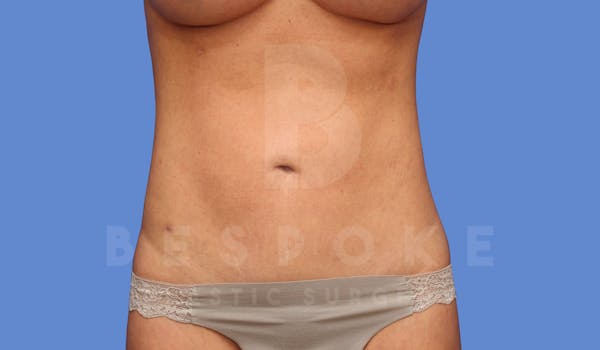 Liposuction Before & After Gallery - Patient 144170669 - Image 2