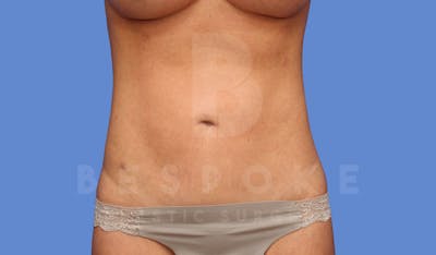 Liposuction Before & After Gallery - Patient 144170669 - Image 2