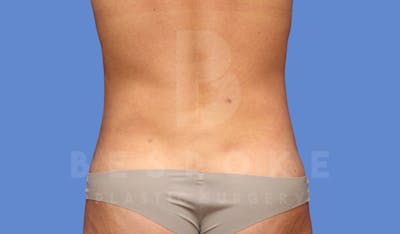 Liposuction Before & After Gallery - Patient 144170668 - Image 2
