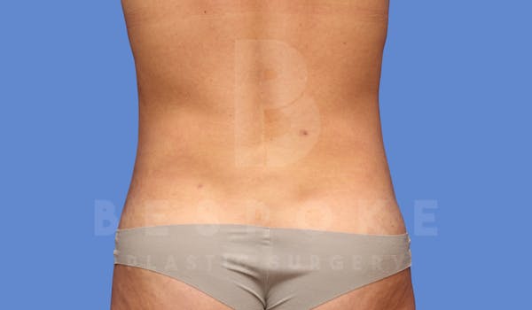 Liposuction Before & After Gallery - Patient 144170668 - Image 2