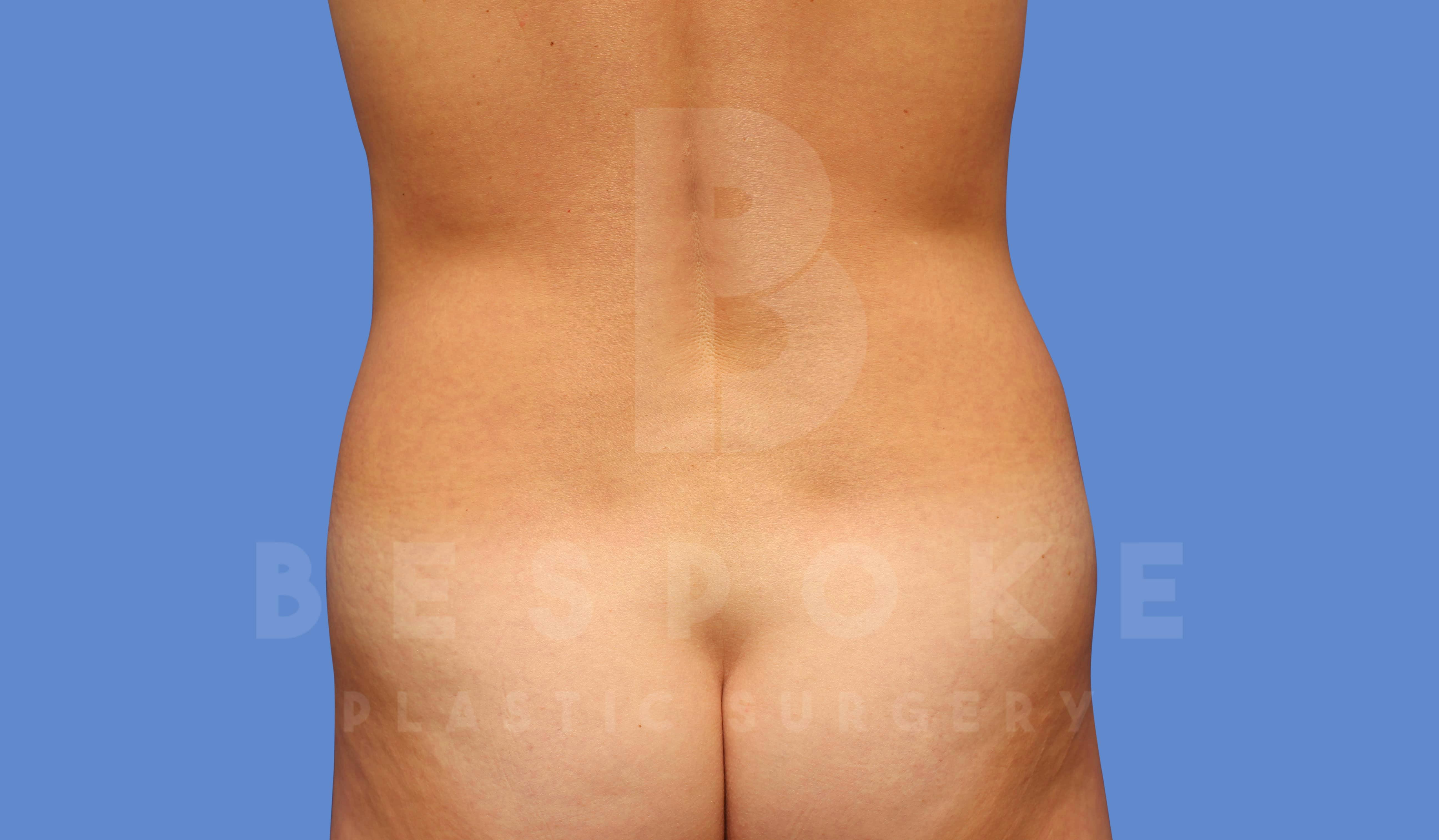 Liposuction Before & After Gallery - Patient 144170668 - Image 1