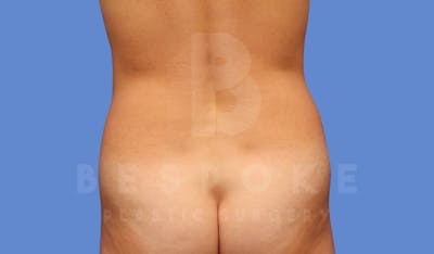 Liposuction Before & After Gallery - Patient 144170668 - Image 1