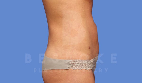 Liposuction Before & After Gallery - Patient 144170668 - Image 4