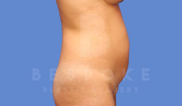 Liposuction Before & After Gallery - Patient 144170668 - Image 3