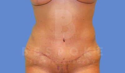 Massive Weight Loss Before & After Gallery - Patient 144170990 - Image 2