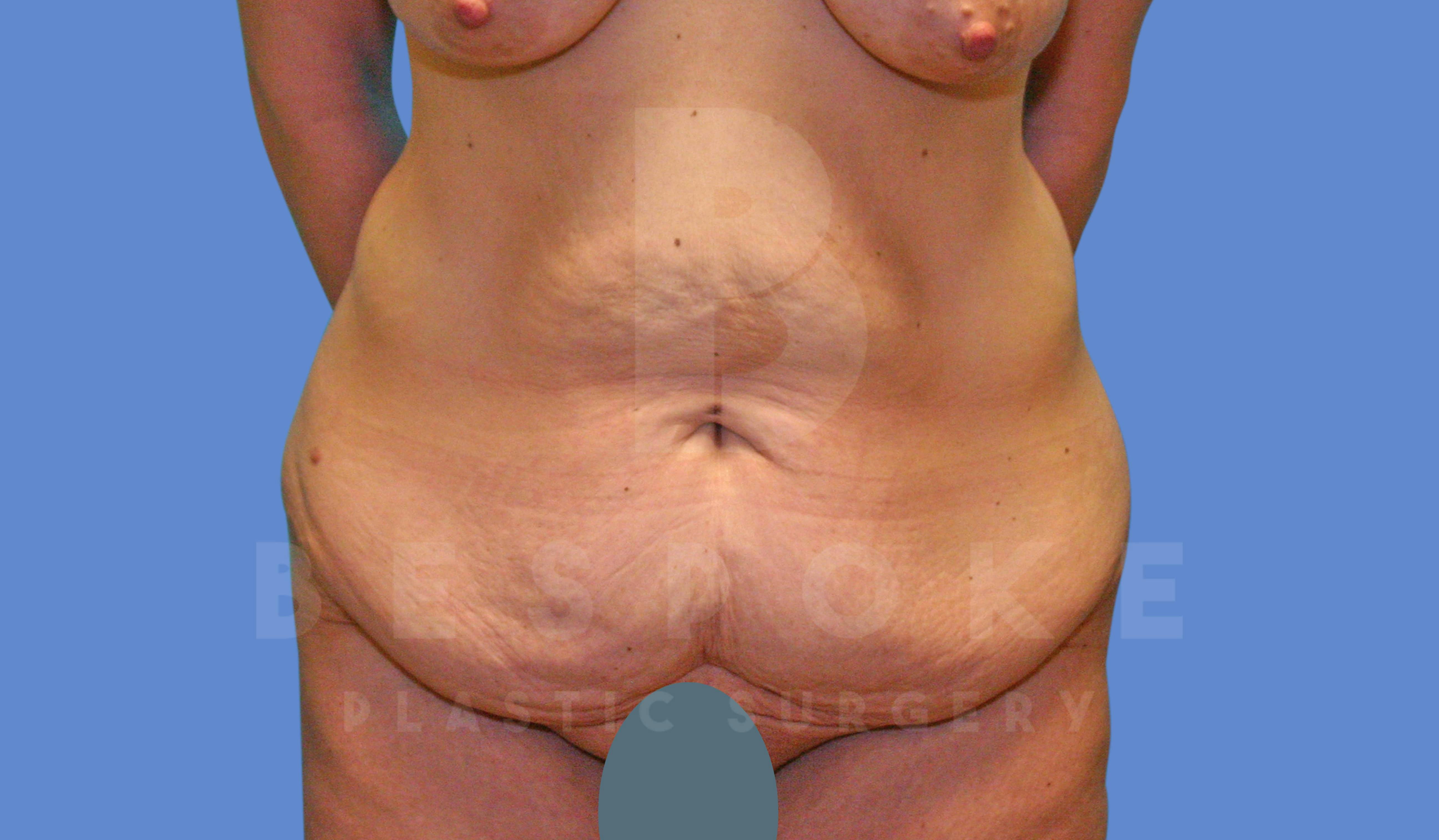 Massive Weight Loss Before & After Gallery - Patient 144170990 - Image 1