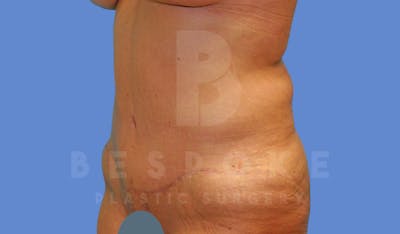 Massive Weight Loss Before & After Gallery - Patient 144170990 - Image 4