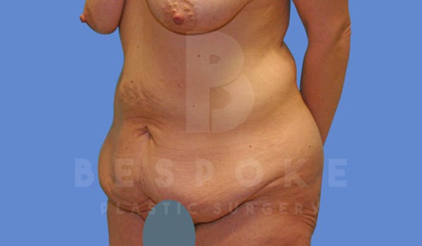 Massive Weight Loss Before & After Gallery - Patient 144170990 - Image 3