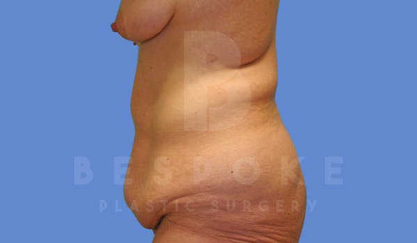 Massive Weight Loss Before & After Gallery - Patient 144170990 - Image 5