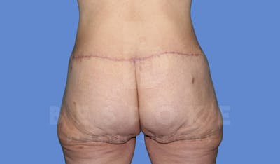 Massive Weight Loss Before & After Gallery - Patient 144170989 - Image 2