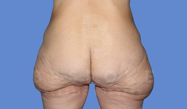 Massive Weight Loss Before & After Gallery - Patient 144170989 - Image 1