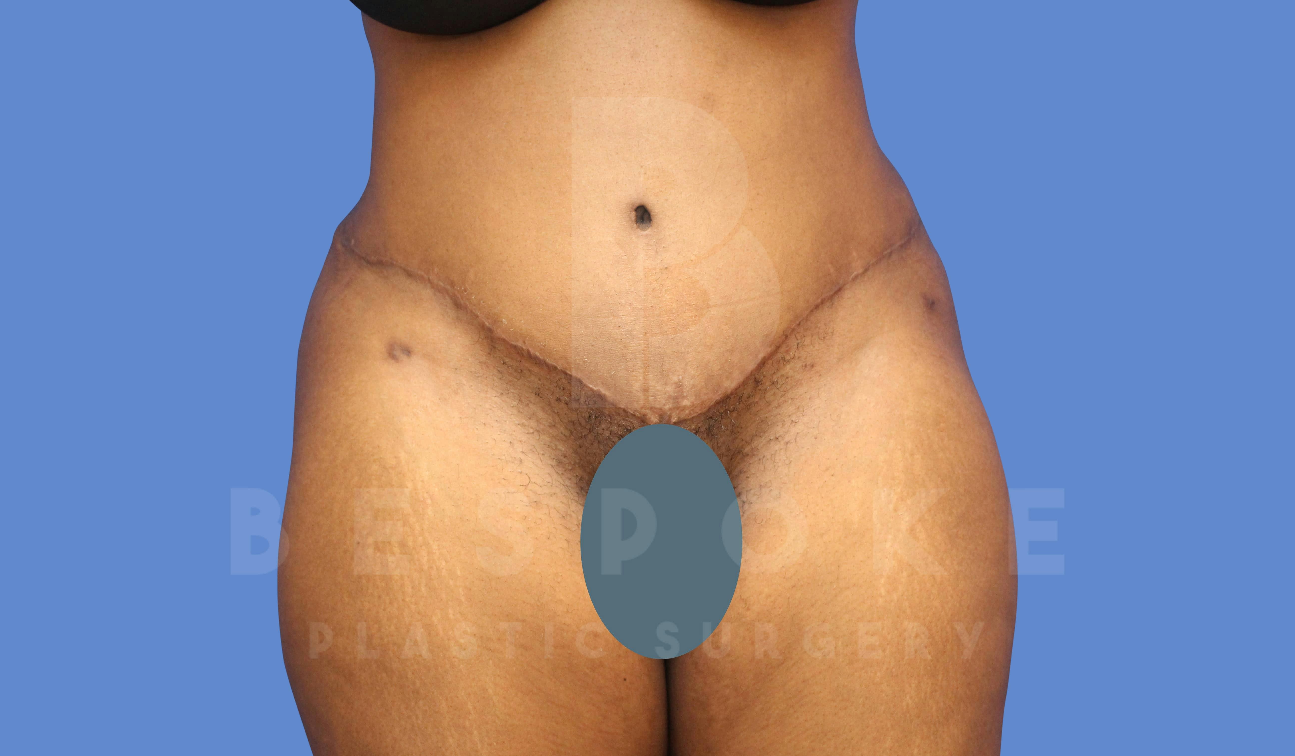 Tummy Tuck Before & After Gallery - Patient 144171069 - Image 2