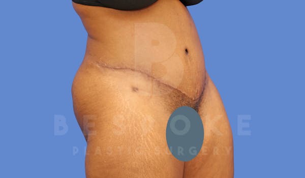 Tummy Tuck Before & After Gallery - Patient 144171069 - Image 4