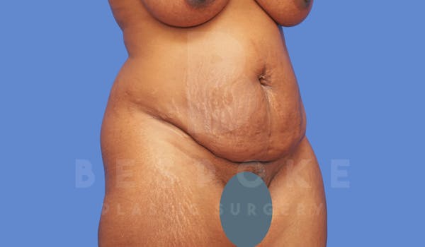 Tummy Tuck Before & After Gallery - Patient 144171069 - Image 3