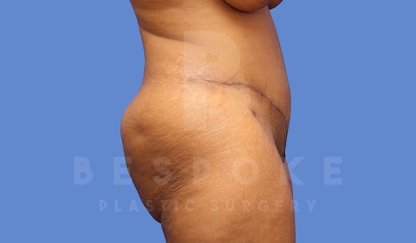 Tummy Tuck Before & After Gallery - Patient 144171069 - Image 6