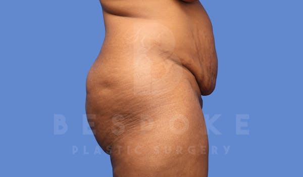 Tummy Tuck Before & After Gallery - Patient 144171069 - Image 5