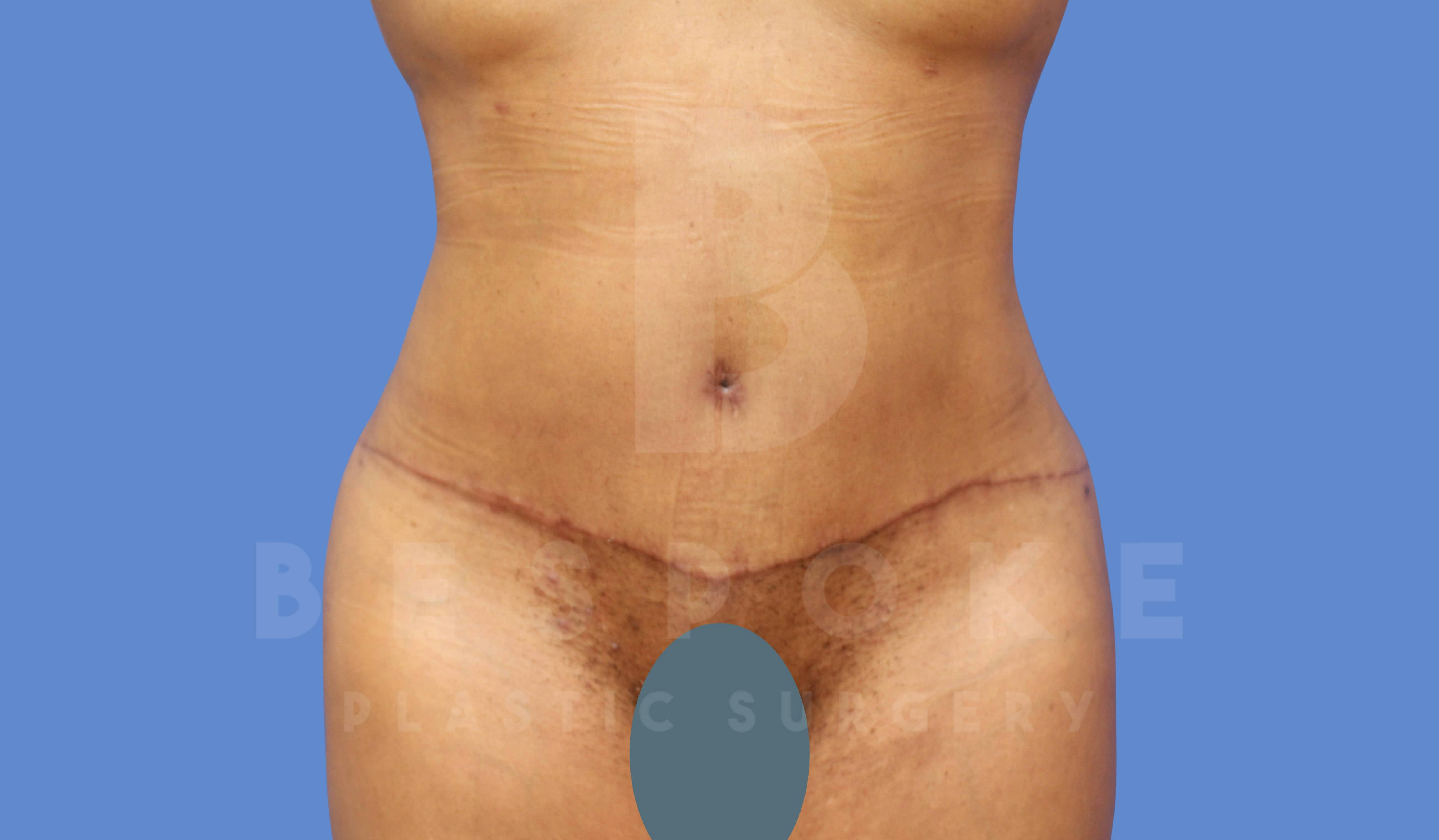 Tummy Tuck Before & After Gallery - Patient 144171068 - Image 2