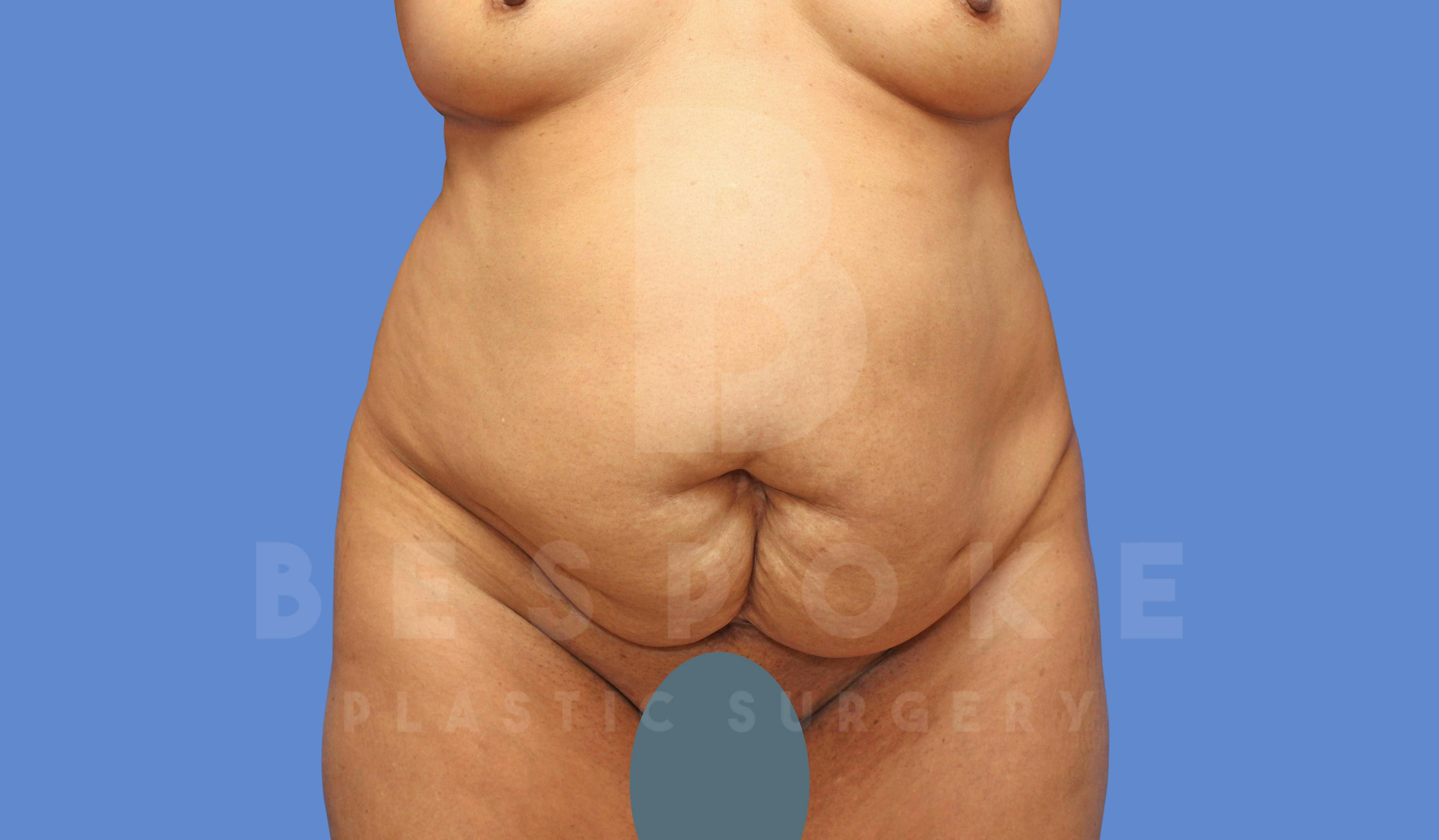 Tummy Tuck Before & After Gallery - Patient 144171068 - Image 1