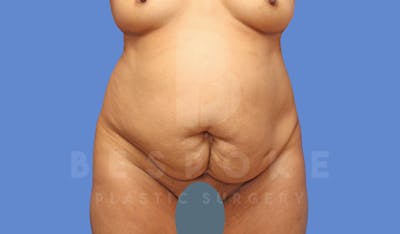 Tummy Tuck Before & After Gallery - Patient 144171068 - Image 1
