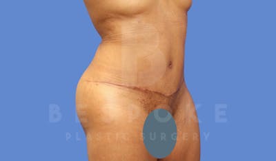 Tummy Tuck Before & After Gallery - Patient 144171068 - Image 4
