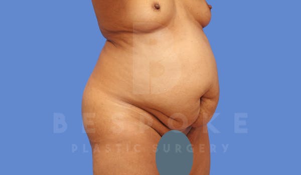 Tummy Tuck Before & After Gallery - Patient 144171068 - Image 3
