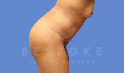 Tummy Tuck Before & After Gallery - Patient 144171068 - Image 6