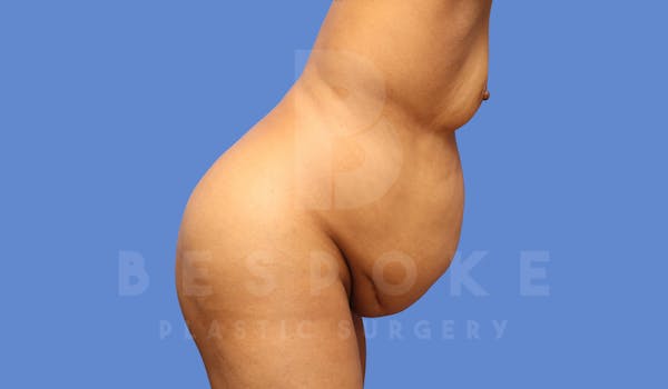 Tummy Tuck Before & After Gallery - Patient 144171068 - Image 5
