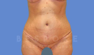 Tummy Tuck Before & After Gallery - Patient 144207900 - Image 2