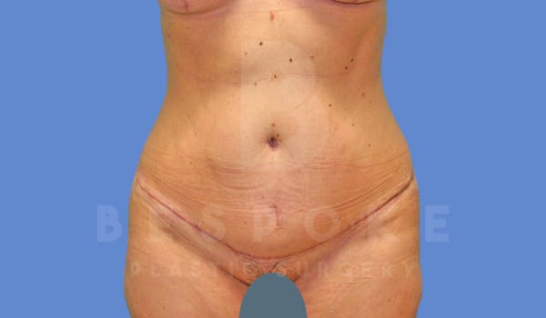 Tummy Tuck Before & After Gallery - Patient 144207900 - Image 2