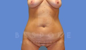 Charlotte NC Before & After Tummy Tuck