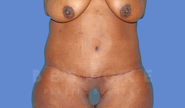 Tummy Tuck Before & After Gallery - Patient 144207899 - Image 2
