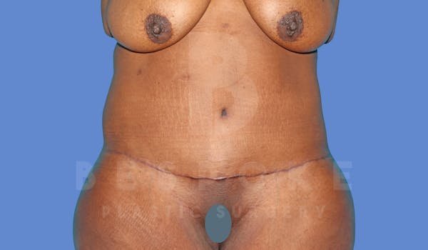 Extended Tummy Tuck Before & After Gallery - Patient 264971 - Image 2