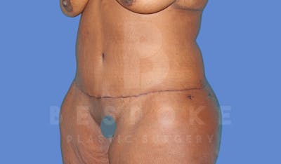 Extended Tummy Tuck Before & After Gallery - Patient 264971 - Image 4