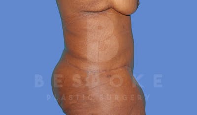 Tummy Tuck Before & After Gallery - Patient 144207899 - Image 6