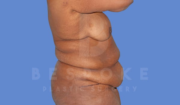 Tummy Tuck Before & After Gallery - Patient 144207899 - Image 5