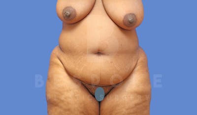 Tummy Tuck Before & After Gallery - Patient 144207898 - Image 1