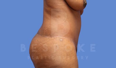 Tummy Tuck Before & After Gallery - Patient 144207898 - Image 6