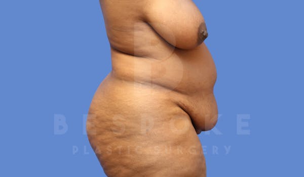 Tummy Tuck Before & After Gallery - Patient 144207898 - Image 5