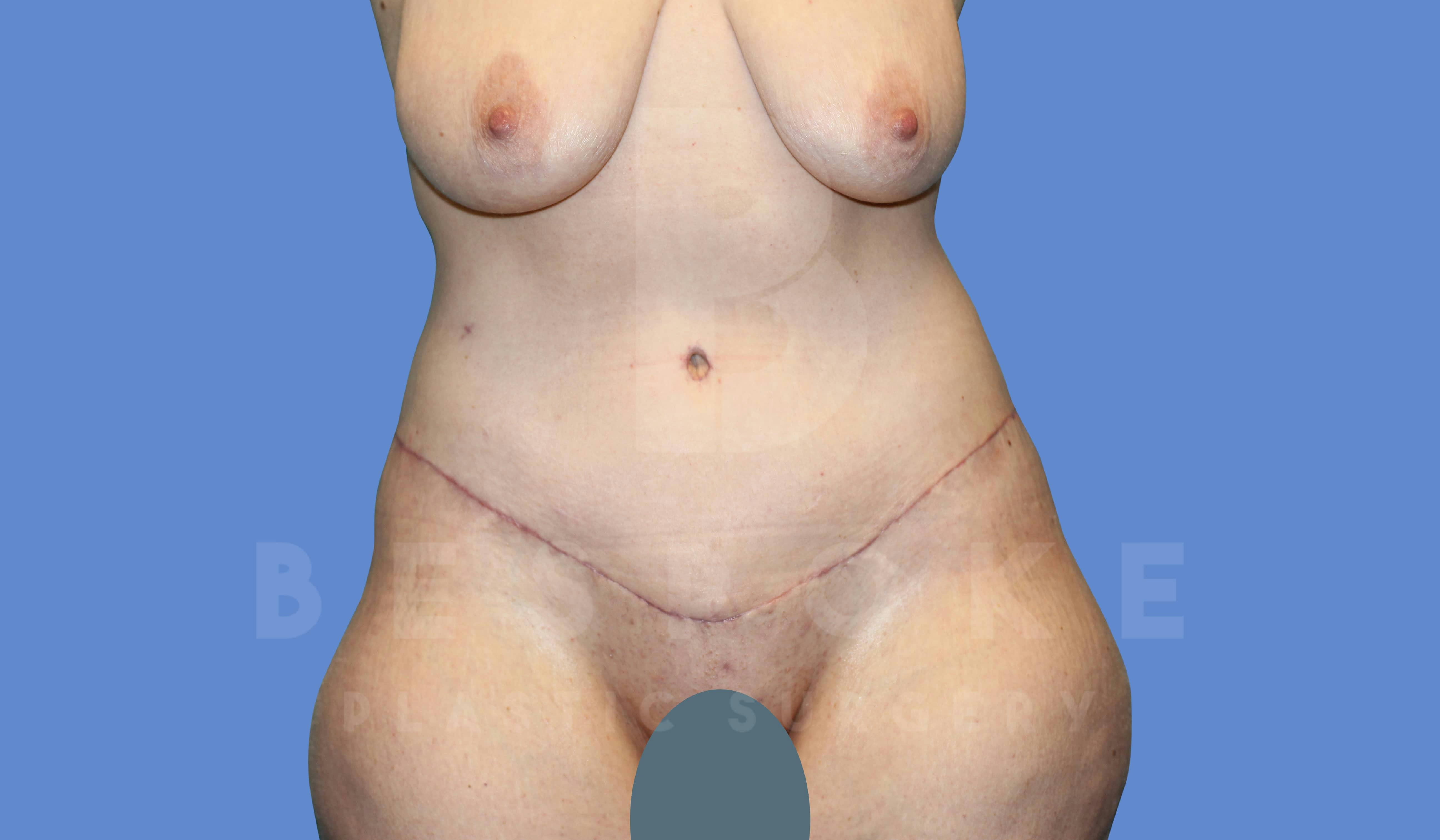 Tummy Tuck Before & After Gallery - Patient 144207897 - Image 2