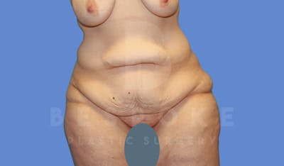 Tummy Tuck Before & After Gallery - Patient 144207897 - Image 1