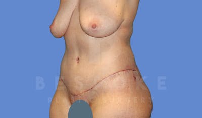 Tummy Tuck Before & After Gallery - Patient 144207897 - Image 4