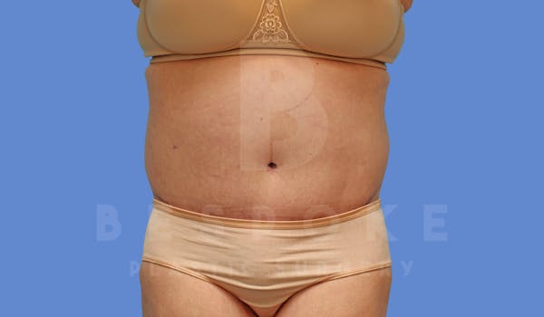 Massive Weight Loss Before & After Gallery - Patient 144207999 - Image 2