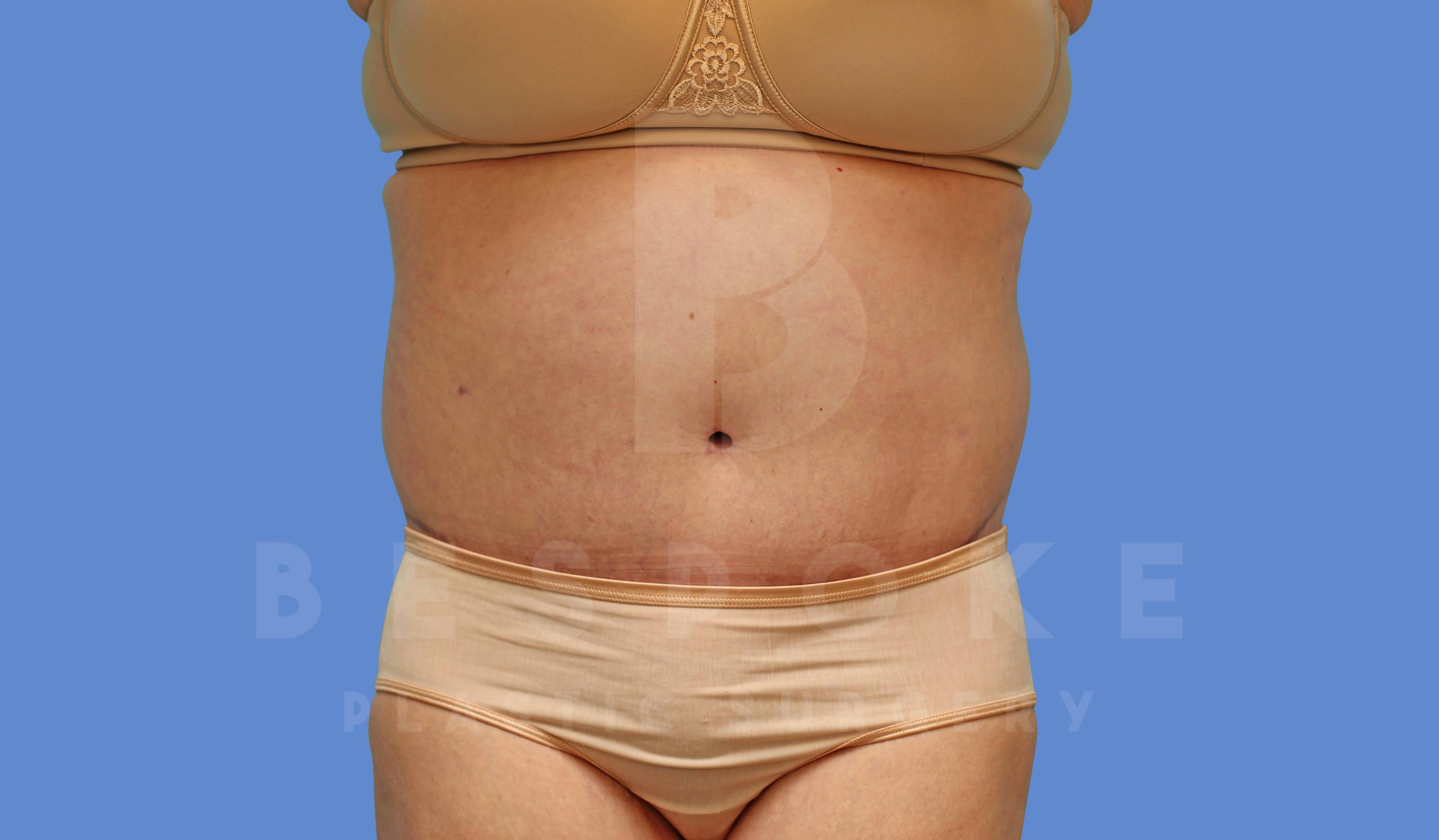 Massive Weight Loss Before & After Gallery - Patient 144207999 - Image 2