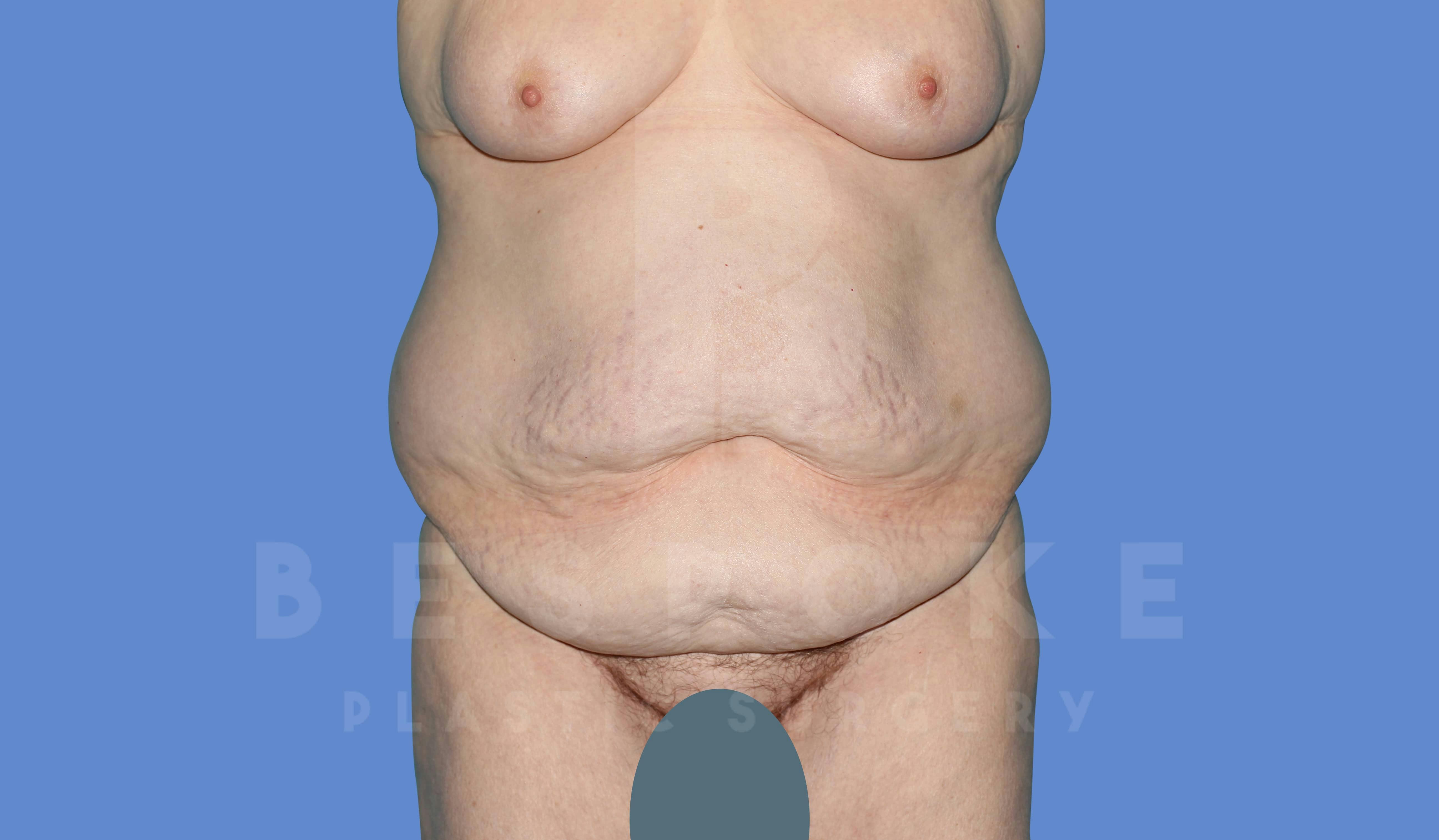 Massive Weight Loss Before & After Gallery - Patient 144207999 - Image 1