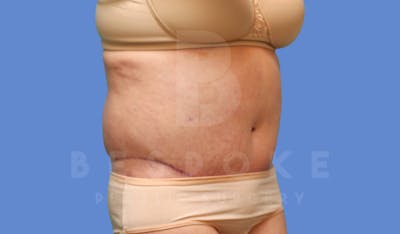 Massive Weight Loss Before & After Gallery - Patient 144207999 - Image 4