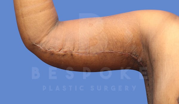 Massive Weight Loss Before & After Gallery - Patient 144207998 - Image 4
