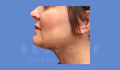 Liposuction Before & After Gallery - Patient 144208087 - Image 2