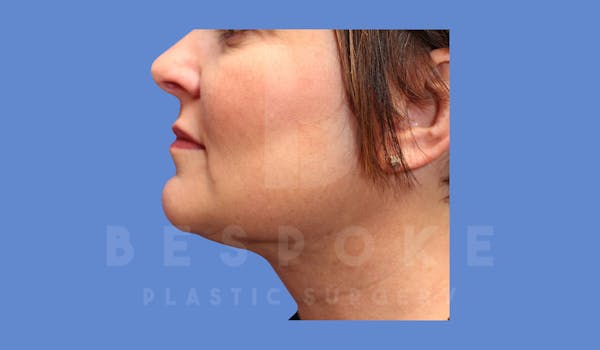 Liposuction Before & After Gallery - Patient 144208087 - Image 2